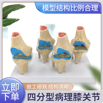 病变膝关节模型 骨科教学展示膝盖 骨质曾生 病理膝关节骨骼模型