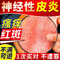 神经性皮炎外用膏顽固无激素皮肤病真菌感染湿疹止痒去顽固根EM