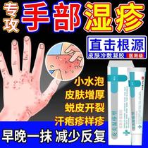 手部湿疹干裂止痒脱皮手套手癣膏汗疱水泡去真菌感染根角化型WW